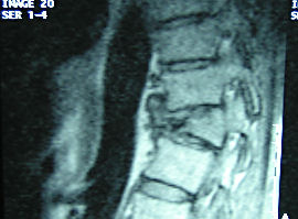 Cifose Ps-Fractura RM