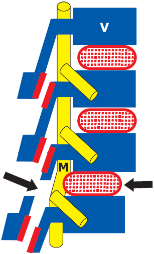 Esquema de Espondilolistese