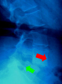 Radiograma Espondilolistese