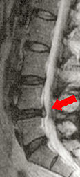 RM Hrnia Longitudinal