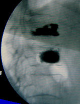 Vertebroplastia