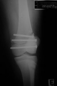 Fractura-Epifisiolise distal do fmur operada AP